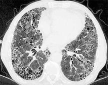 La fibrose pulmonaire idiopathique