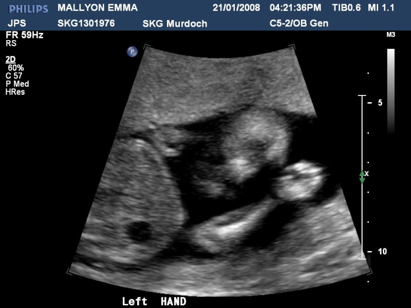Ultrasound Pictures 21_jan13