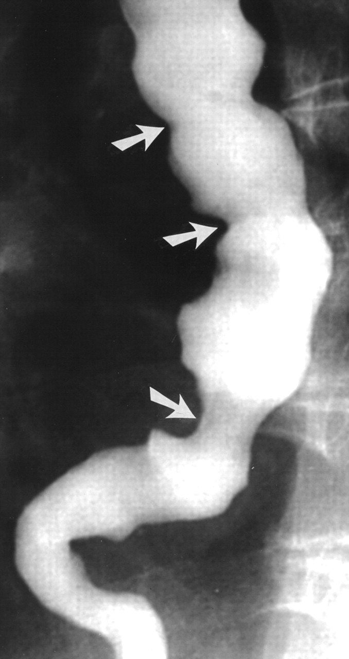 Barium swallow in a case of chest pain & dysphagia 08_03_11