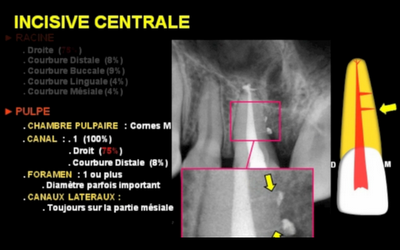 Anatomie endodontique des incisives maxillaires et mandibulaires [vidéo] Ics10