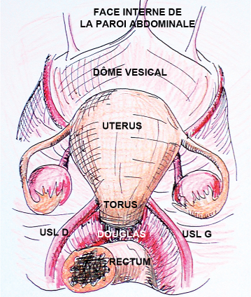 Torus utérin  Rms_4410