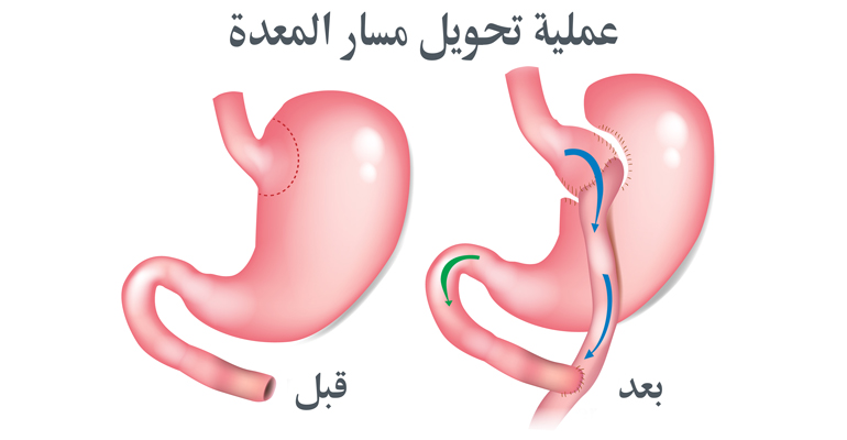 تحويل مسار المعدة..لخسارة وزنك بسهولة  Oyioa-12