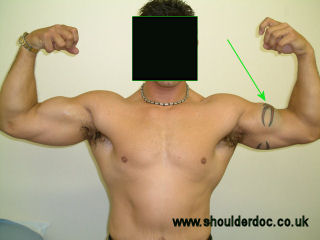 Rupture du tendon du biceps Distal10