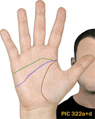 Simian line: advanced considerations! Distal10