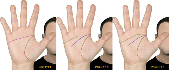 Simian Line / Single Transverse Palmar Crease Simian10