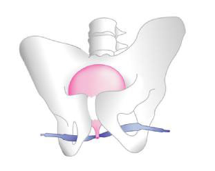 Pose de bandelettes urinaire Fig210