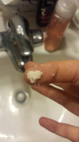 Can Metronidazole Gel Cause White Clumpy Discharge