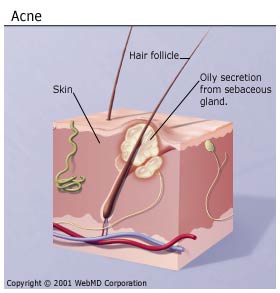 علاج حب الشباب Acne_110