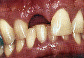 زراعة الأسنان : الأسنان استبدال هذا الشكل والمظهر مثل بنفسك Implan10