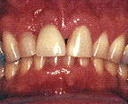 زراعة الأسنان : الأسنان استبدال هذا الشكل والمظهر مثل بنفسك Implan11