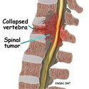 أورام الحبل الشوكي  Spinal Cord Tumors Spinal10