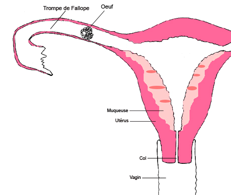  La grossesse extra-utérine Grosse10