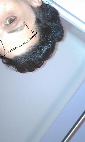 hairline regrowth  - Page 9 Nov_2110