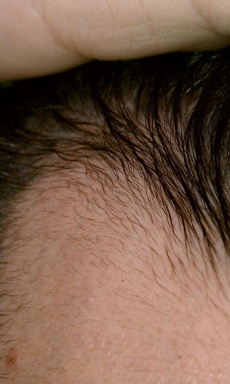 hairline regrowth  - Page 8 Sucess10