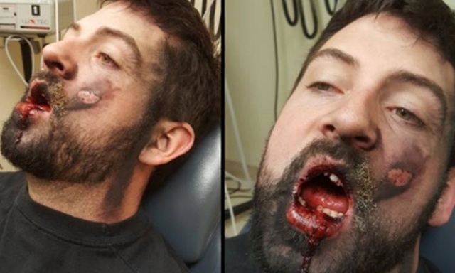 Il essaie d'arrêter de fumer et sa cigarette électronique lui explose au visage ! Main_r10
