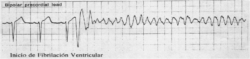 ELECTROCARDIOGRAMAS EN URGENCIAS - Página 3 Fv10