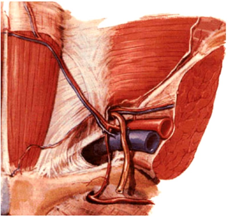 Orifice profond du canal inguinal : ligament de Hesselbach et tendon conjoint Fig23-10