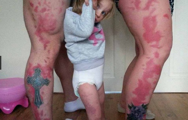 Des parents se font tatouer pour imiter la tache de naissance de leur fille 648x4112