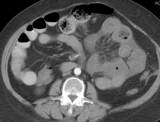 ABC RADIO - SURGERY   Recurrent Abdominal Pain With Abdominal Distention  Image111