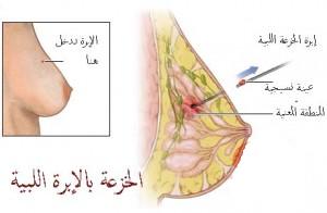 خزعة الثدي Breast Biopsy 55555510