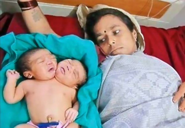 India: nato bimbo con due teste, ma sta bene Bimbod10