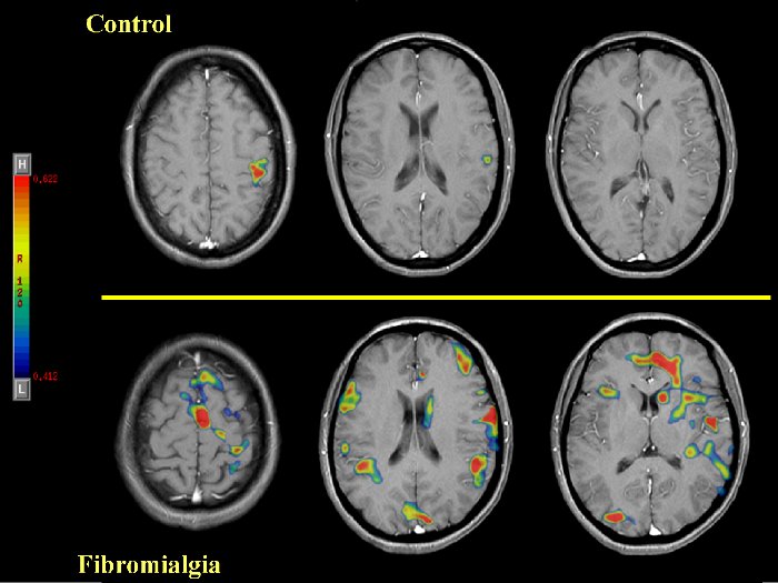 Se puede ver el dolor? Resonancia magntica funcional y FM Cortes10