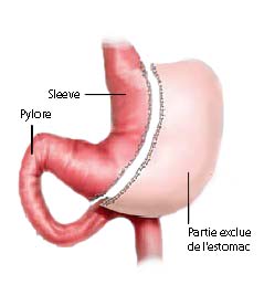 Technique de la gastrectomie longitudinale (ou gastrectomie en manchon ou sleeve gastrectomy) Sleeve11