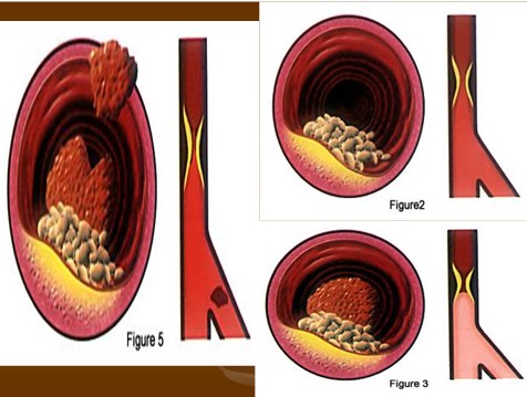 COMMENT REDUIRE LE CHOLESTEROL ET LES TRIGLYCERIDES Chol310