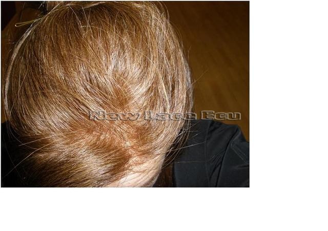 Protesis capilar para alopecia femenina...todo se puede! 099re10