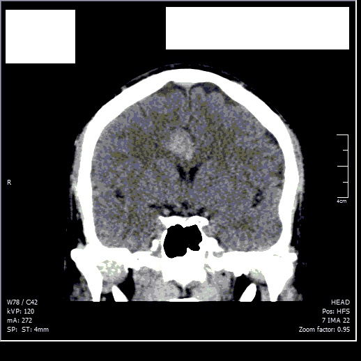 Hairloss caused by intracranial pressure? Scan_c12