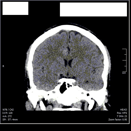 Hairloss caused by intracranial pressure? Scan_c13