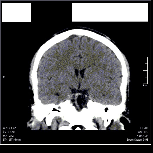 Hairloss caused by intracranial pressure? Scan_c14