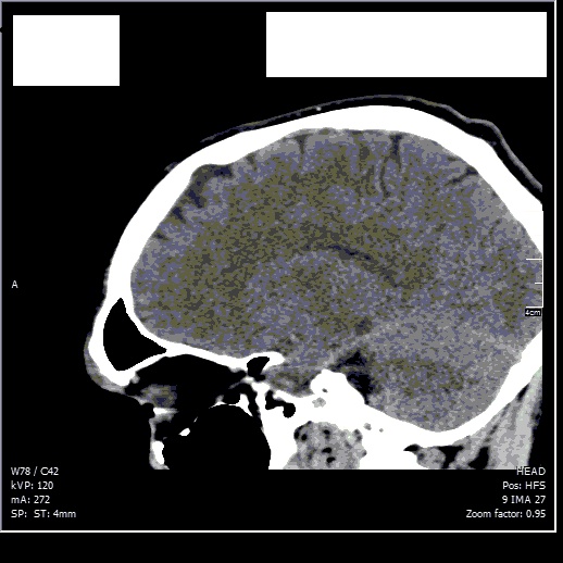 Hairloss caused by intracranial pressure? Scan_c15