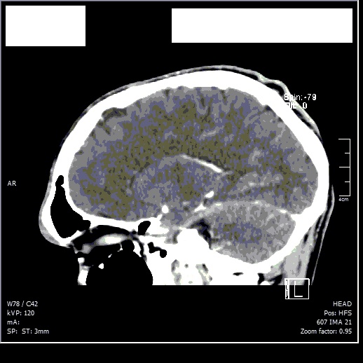 Hairloss caused by intracranial pressure? Scan_c16