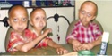 Hutchinson Gilford Progeria and Palmistry ! 2009-110