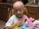 Hutchinson Gilford Progeria and Palmistry ! Proger10