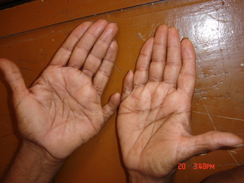 Man with 12 fingers and toes - Polydactyly Six_fi10