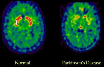 Increased risk of Parkinson's disease with Methamphetamine use Brainp10