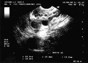 Stimolazione Ovarica e Monitoraggio Ormonale dell'Ovulazione Follic10