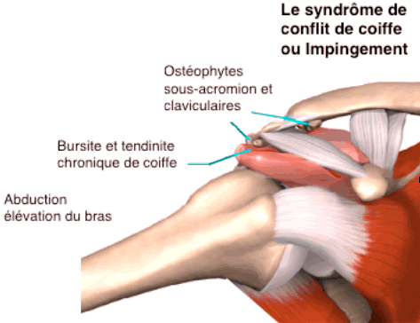 Tir back tension et douleurs Coiffe10