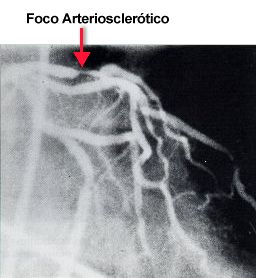 ARTERIOSCLEROSIS Arteri11