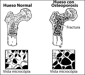 OSTEOPOROSIS E136_p10