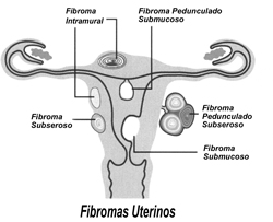 LOS MIOMAS O FIBROMAS Mioma110