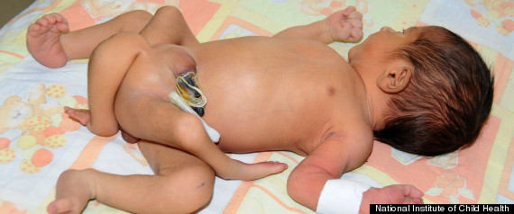 Un bébé nait avec 6 jambes R-baby10