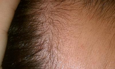 hairline regrowth  - Page 7 Dec10_10