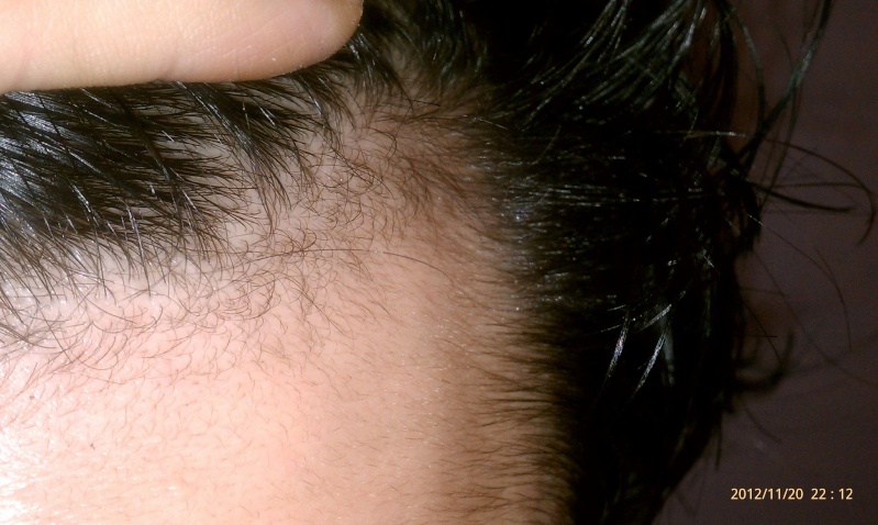 hairline regrowth  - Page 6 Nov2010