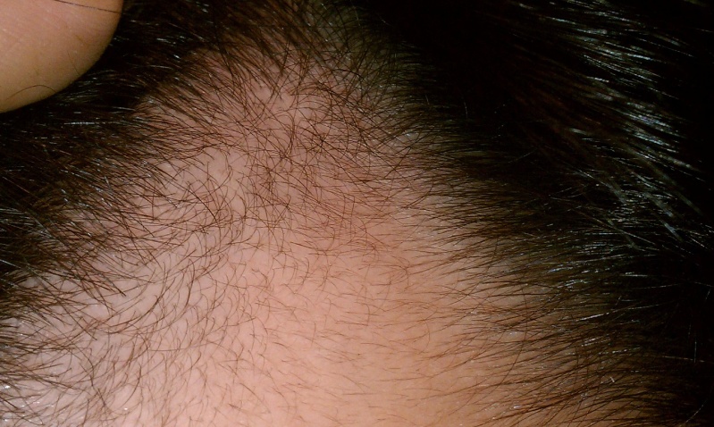 hairline regrowth  - Page 7 Nov2610