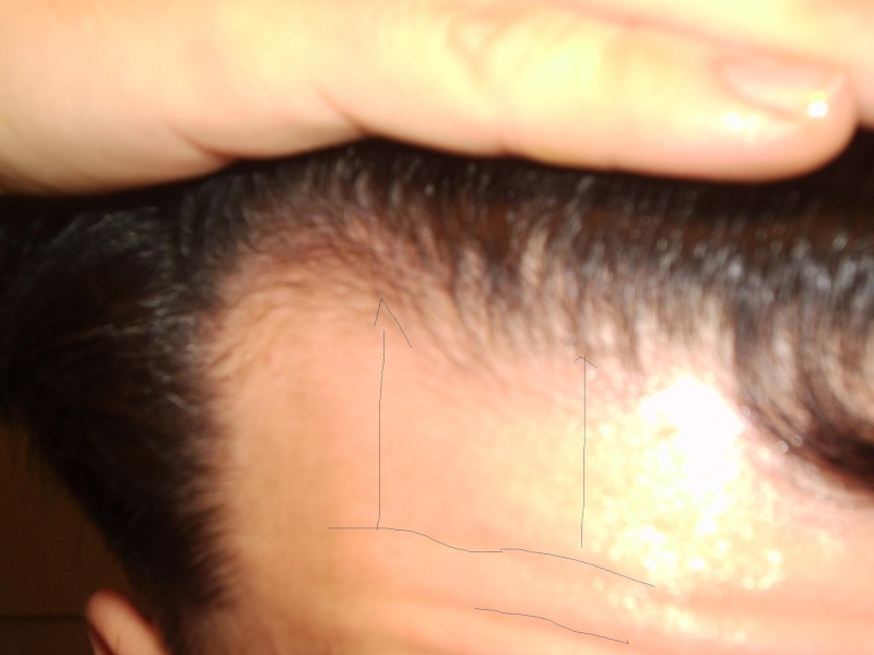 hairline regrowth  - Page 3 Week1_10