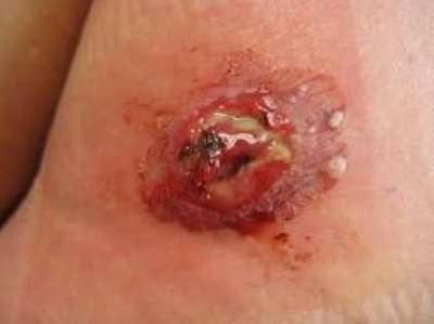 إكتشاف بكتريا قاتلة من نوع MRSA تنتشر في قطاع غزة .. بسبب القطط Sda16