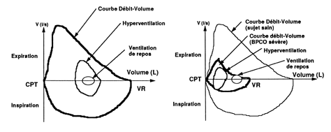 Décompensation respiratoire 96_34-10